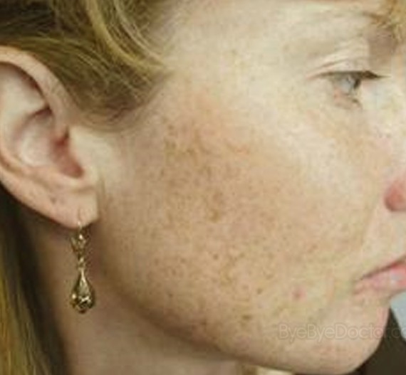 How can I get rid of brown blotches on my face? | Zocdoc ...