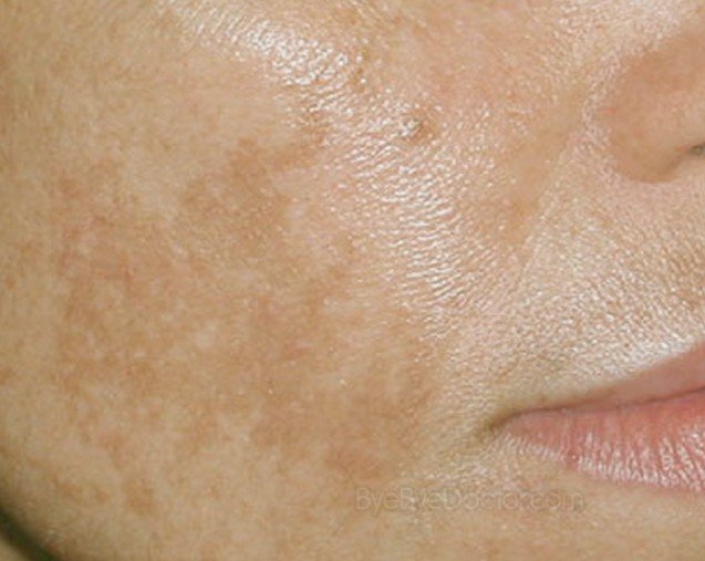 Dry Skin Patch On Face Skin Cancer