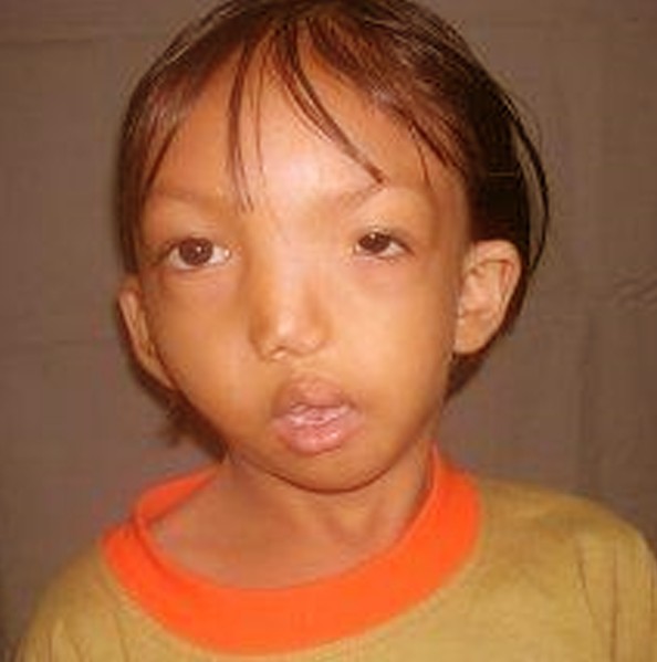 goldenhar syndrome pictures