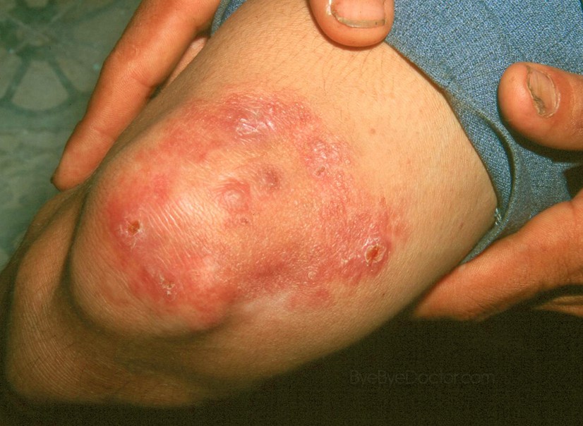 indeterminate leprosy