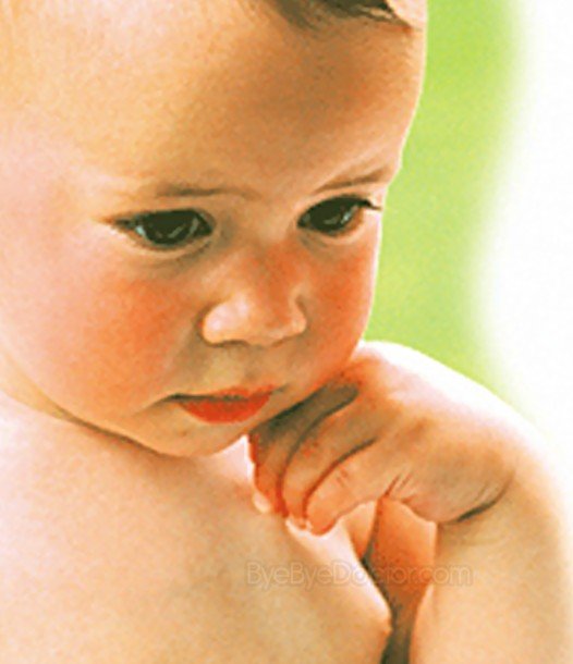 measles rash pictures