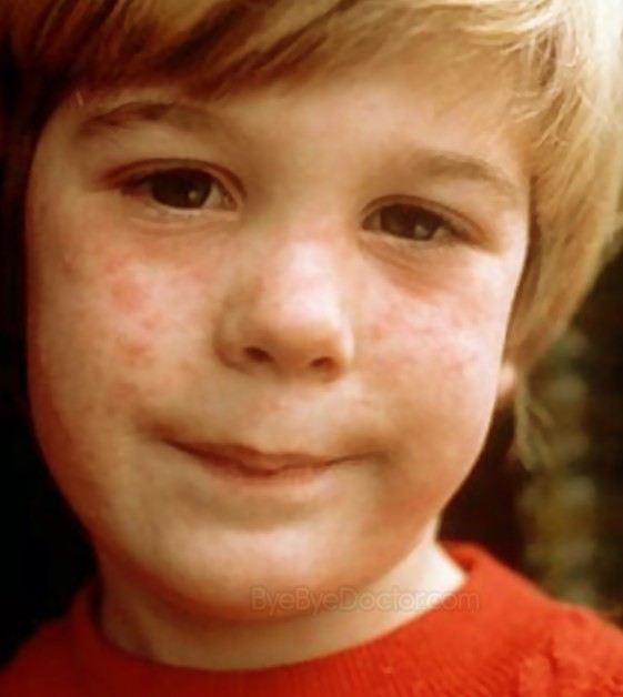 measles rash pictures