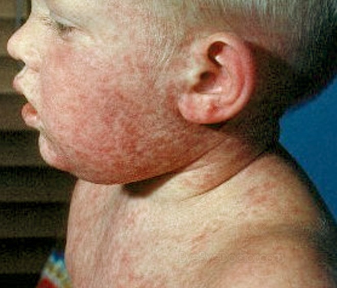Roseola - the Web's most visited site about children's health