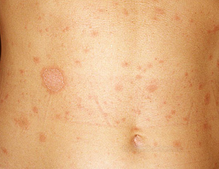 Nov 13, 2010. other diseases with pityriasis rosea symptoms numular eczema and pityriasis  rosea of pityriasis rosea photos pityriasis rosea pityriasis rosea.