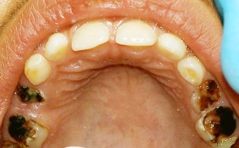 tooth-decay-pictures-treatment-symptoms-causes