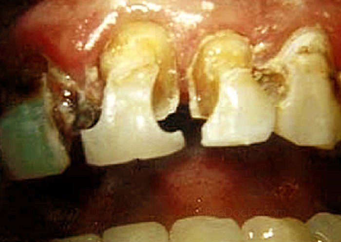 tooth-decay-pictures-treatment-symptoms-causes