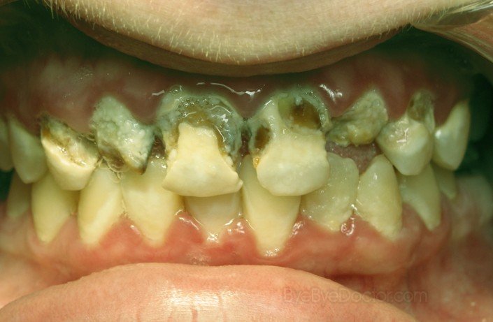 tooth decay pictures