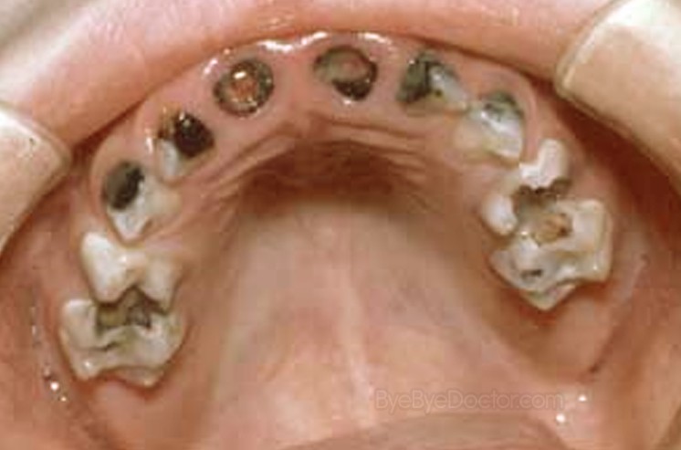 tooth decay pictures