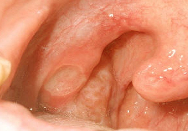 mouth ulcers pictures