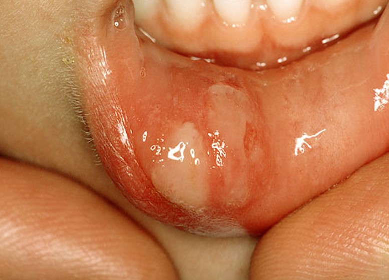 mouth ulcers pictures