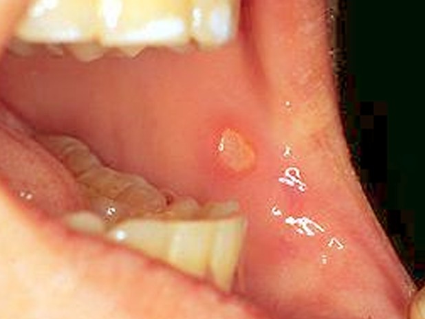 mouth ulcers pictures
