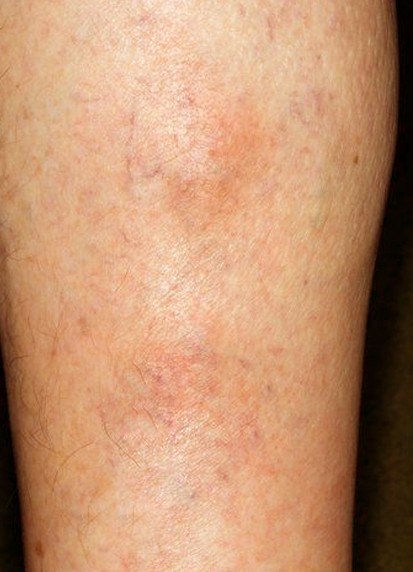 thrombophlebitis pictures