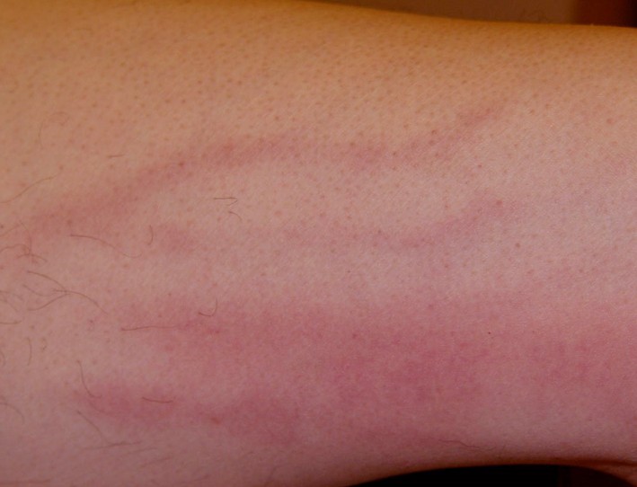 thrombophlebitis pictures
