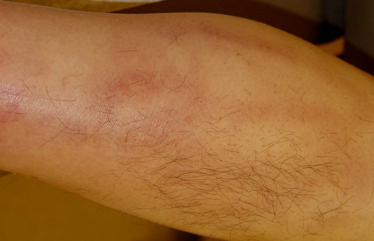 thrombophlebitis pictures