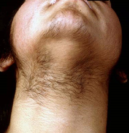 hirsutism pictures