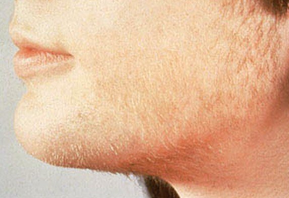 hirsutism pictures