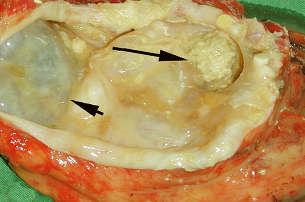 teratoma pictures