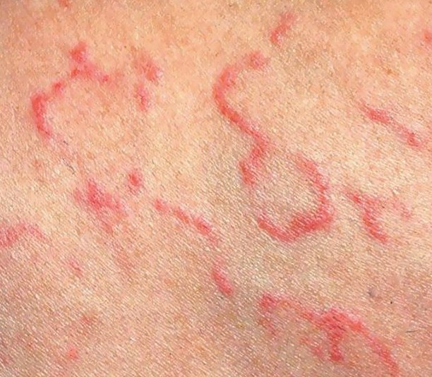 Erythema | definition of erythema by Medical dictionary