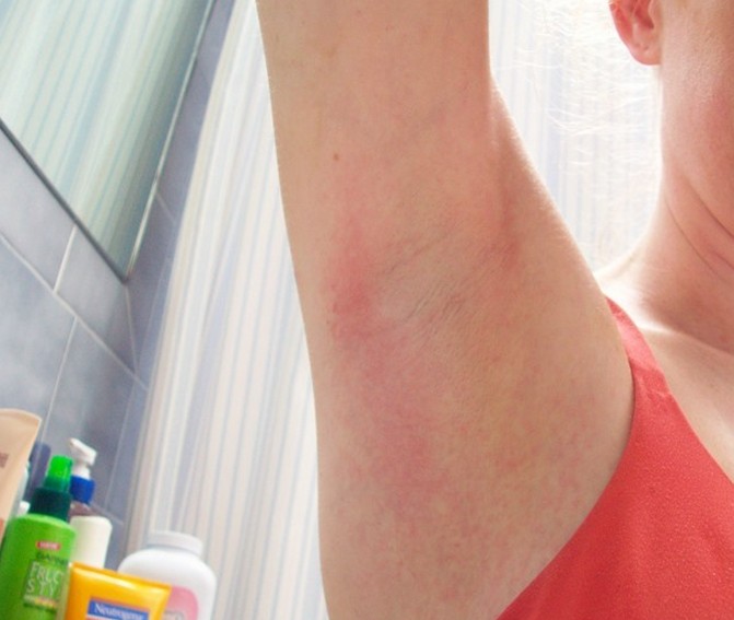 What Is Circular Red Rash Under Armpit