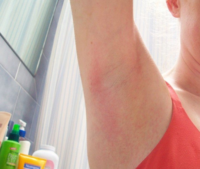 underarm-rash-cause-pictures-photos