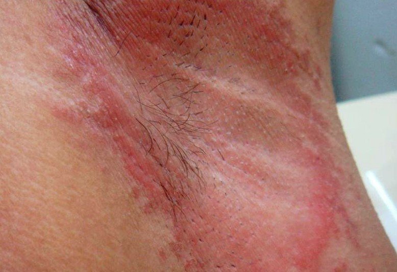 Underarm Rash Pictures Treatment Symptoms Causes