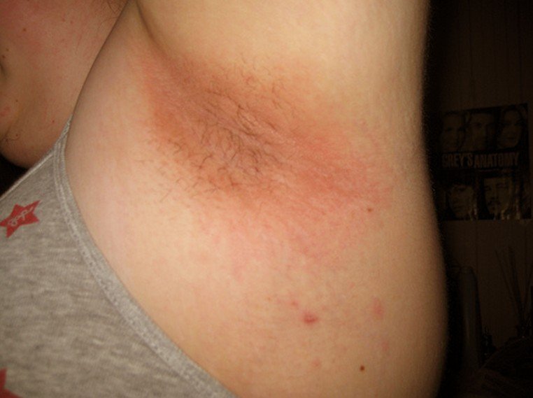 Armpit Rash | Healthcare-Online