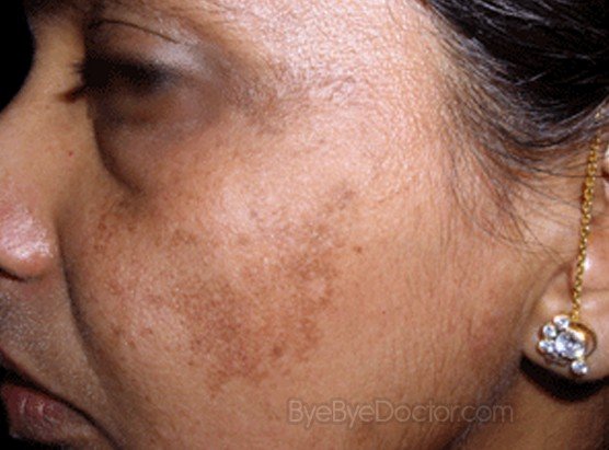 Well known Treatment melasma upper lip ~ Skinny