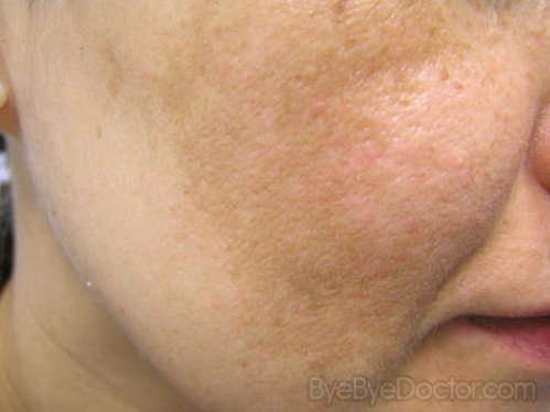 Melasma Treatment, Pictures, Causes, Symptoms, Cure