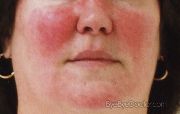 New acne treatment today tonight, cure for acne rosacea