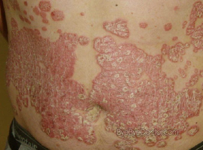 Plaque Psoriasis