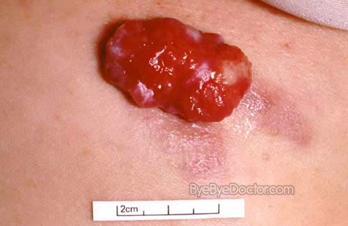 Pyogenic Granuloma – Symptoms, Causes, Pictures, Treatment