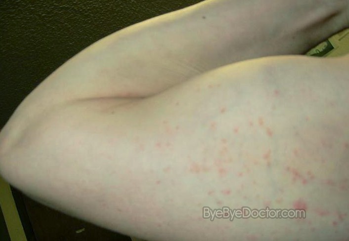 Pimples on Arms