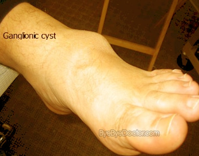 Ganglion Cyst Foot