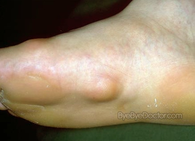 Fibroma on bottom of foot