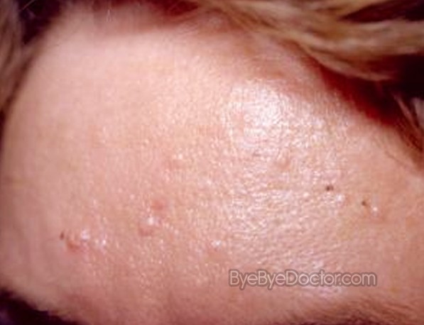 Sebaceous Hyperplasia - Treatment, Removal, Pictures ...