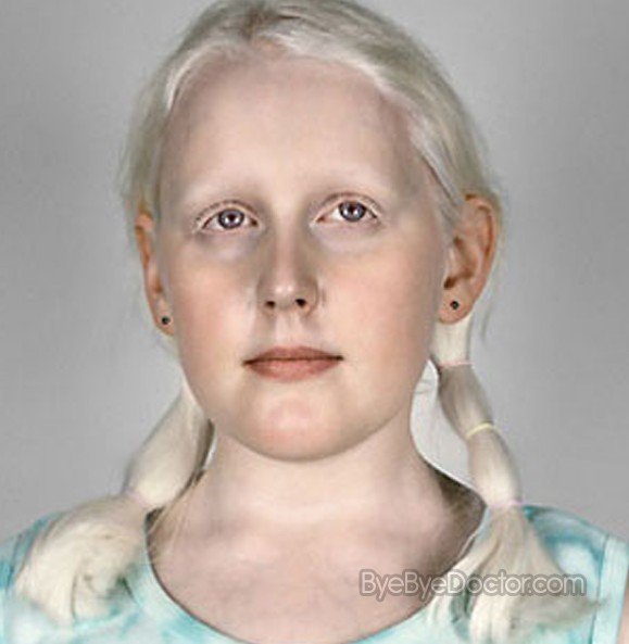 Albinism - Picture   s, Facts, Symptoms, Causes, Treatment