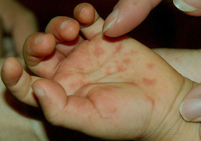 hand foot and mouth disease pics