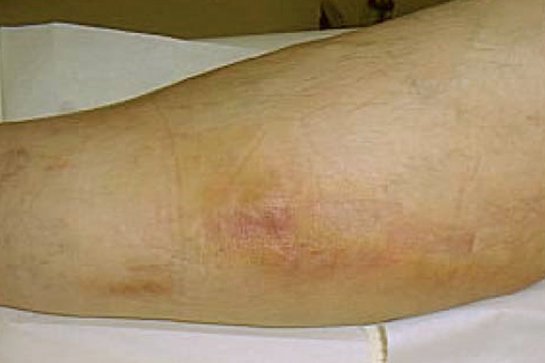 Phlebitis - Pictures, Symptoms, Causes, Treatment