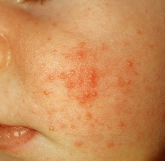 Red Bumps On Face