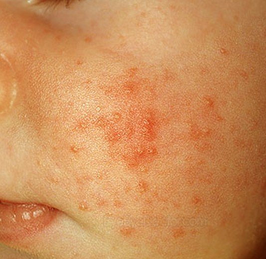 Red Itchy Bumps on Skin - Pictures, Causes, Treatment