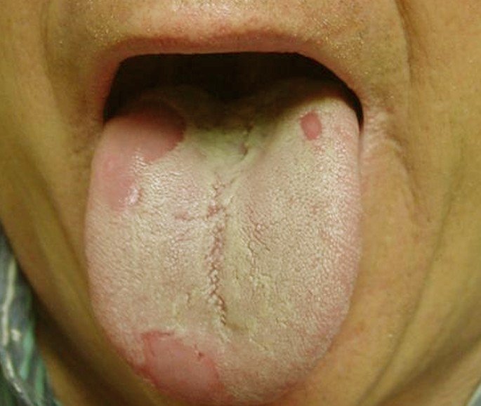 Nasty Porn Tongue - Hairy Tongue Cure - Adult gallery