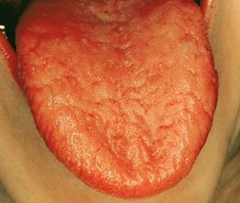 Anemia Dry Mouth 10