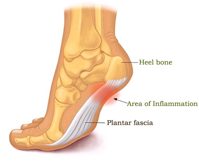 plantar fasciitis pictures